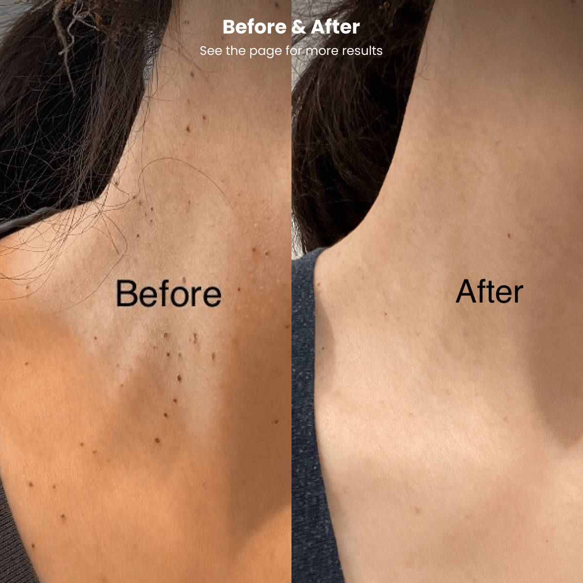 Dermavel - Fibroblast Plasma Pen